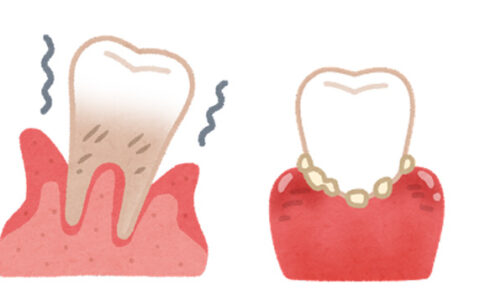 歯周病による体のひずみ