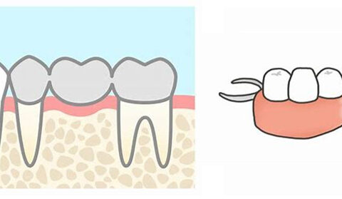 ブリッジと入れ歯