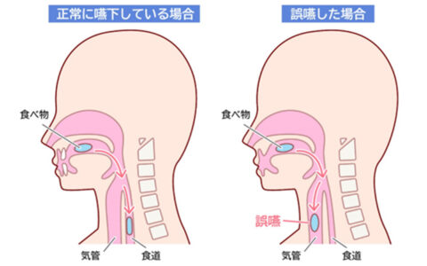 誤嚥性肺炎を予防するために