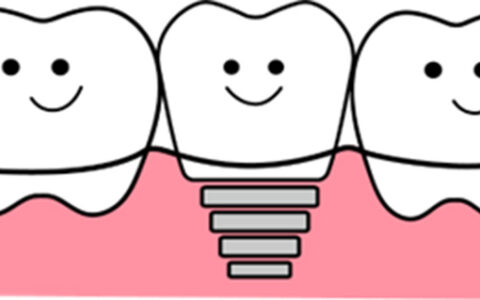 はじめてのインプラント、まずはこれだけ知っておこう！