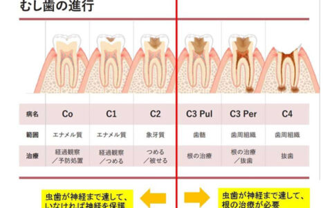 あなたの虫歯の症状をチェックしましょう！