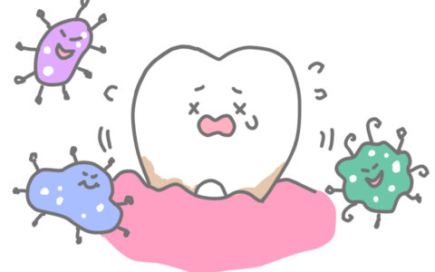 若年性歯周炎について知っておきたいこと