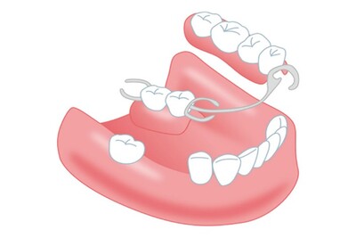入れ歯とブリッジを比べてみよう