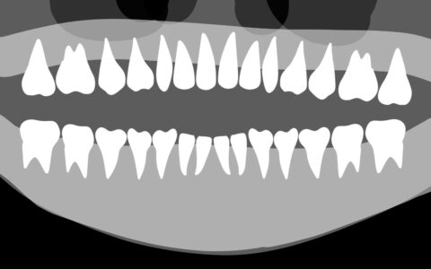 全身の健康を歯のレントゲンでチェック！