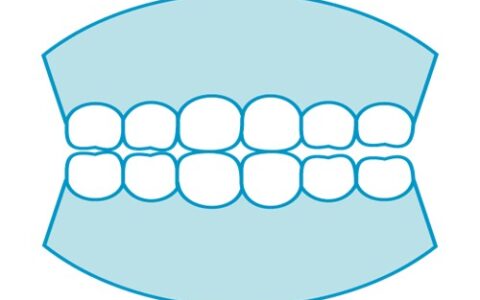 ブリッジと入れ歯の違いについて