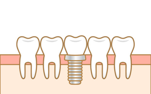 これからの毎日を、安心して過ごすために　〜インプラントという選択肢〜