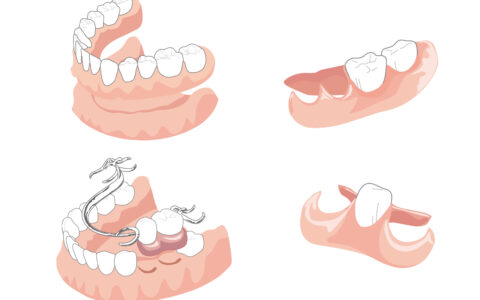 入れ歯とブリッジの特徴と選び方
