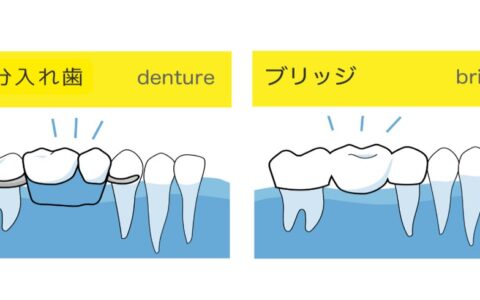 歯を失ったらどうする？入れ歯とブリッジを比較